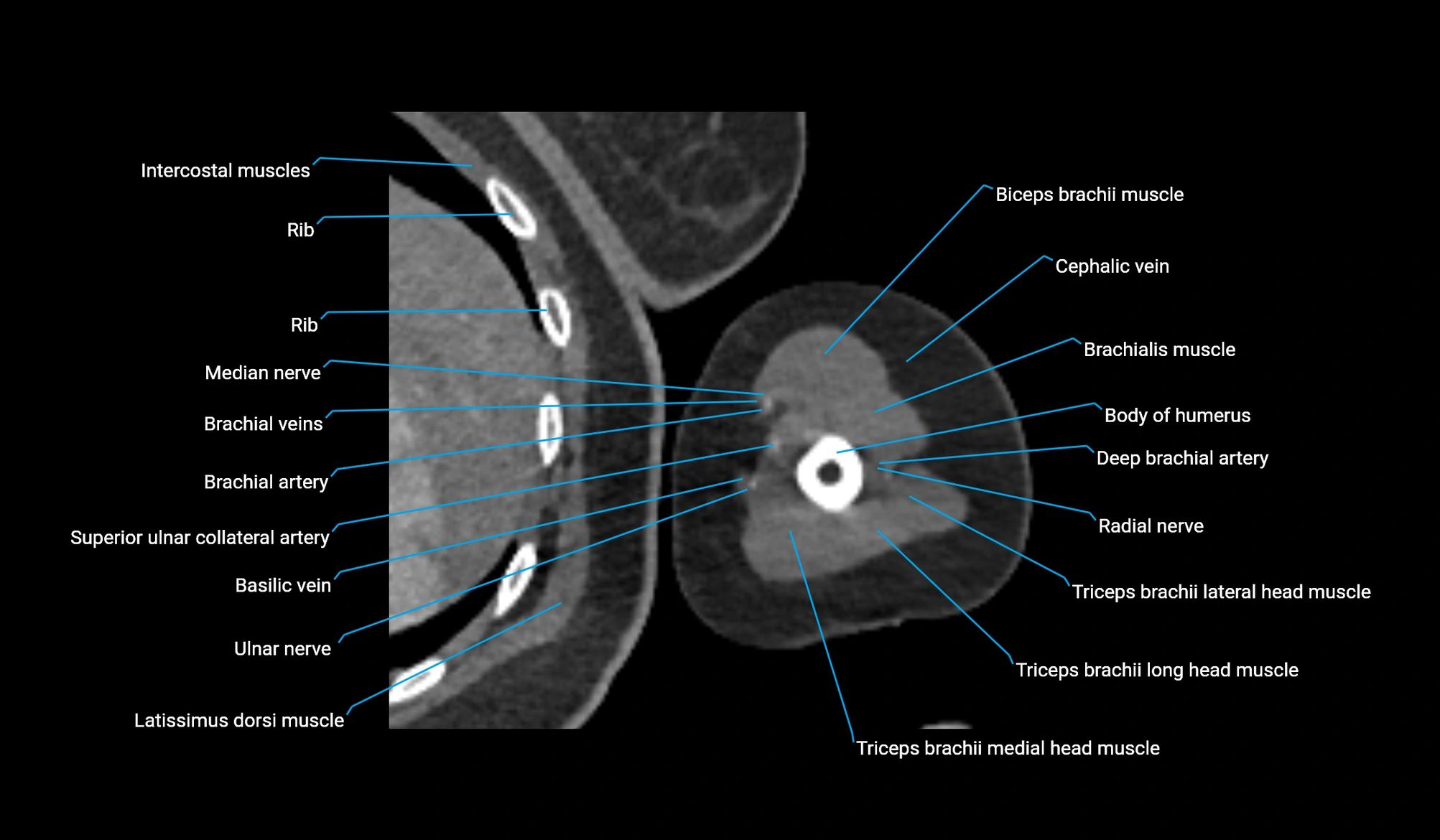 CT upper arm axial  cross sectional anatomy labelled radiology image -00278.webp
